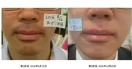 【初回★minimo男性限定】痛くない!メンズヒゲ脱毛(口周り)
