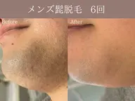 【メンズ髭脱毛】 REVI美肌脱毛