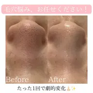 【本日31日1名様限定】即日実感✨全顔毛穴洗浄×美容液で毛穴レス肌へ【黒ずみ毛穴/詰まり毛穴に◎】