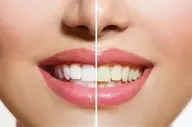 セルフホワイトニング30分【スタンダードコース】