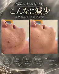 ニキビに悩んでる方限定/ニキビ解消トリートメント