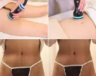 価格満足度No1*【痩身】オンダボディ★痩身はもう脂肪凍結、冷却痩身の次の時代 ※3部位