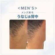 【メンズ脱毛】うなじ背中脱毛2750円ファッションも髪型もキマル💇