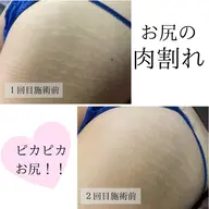 ✨🌿ミニモ学割🌿✨💎人気No.1 肌質改善‼️剥離有りハーブピーリング💎
