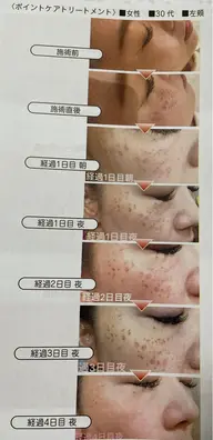 筋膜ホワイト