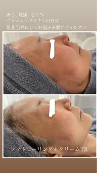 赤ら顔や乾燥肌が気になる方にオススメ!敏感肌さんの角質ケア♪
