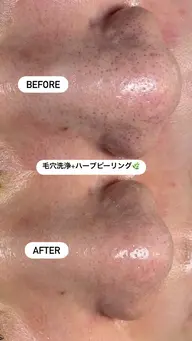 【黒ずみ・開き毛穴に】ハイドラ毛穴洗浄+ハーブピーリング🌿