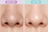 特許取得【毛穴汚れがゴッソリ】水素とスクリューの力で眉間,鼻,アゴの洗浄🌪✨