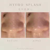 【毛穴悩みまとめてケア✨️】ハイドラフェイシャル🫧モデル募集中🤍
