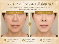【シミ・毛穴・くすみケア】フォト光×美容液導入