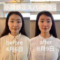 顔写真の撮影モデルさん募集☆小顔修正スパ+フェイスポインターを使用したお顔のツボ押し(痛いやつです)で浮腫を撃退