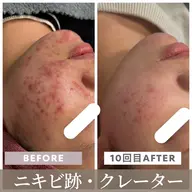 【ニキビ・ニキビ跡・乾燥肌・毛穴】プラズマニードル⚡️