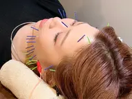 ぱっちりアイリフト美容鍼