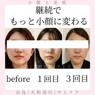 ご新規様限定✨️お得!最短で小顔効果を実感の3回継続、小顔矯正リフトフェイシャルコース