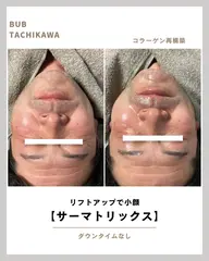 【ハリ&小顔を選べる3部位】サーマトリックスリフトアップ|頬・顎・額から気になる部位を集中ケア