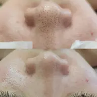 黒ずみごっそり!小鼻ツルツル🫧毛穴エクストラクション