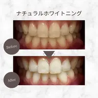 【OPEN記念★10月限定】ナチュラルホワイトニング¥ 3,890→¥1,000！