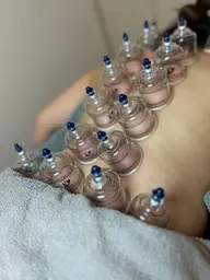 カッピング