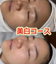 おすすめ✨［FACE］透明感肌へ🦋美白＆保湿＆ピーリング＆小顔マッサージ60分 ¥3980