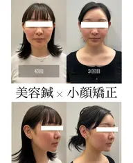 【お顔むくみ・たるみ改善】小顔矯正+頭蓋骨矯正50分 16500円▶︎2200円