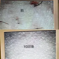 わき脱毛　8回
