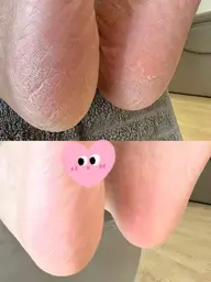 フットケア