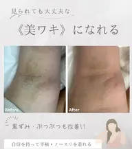 脇脱毛