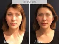 小顔即効性◎🔸独自の最新マシンlifit✖️高周波温熱ケアダブル施術♪ 首/頭まで【カウンセリング込み100分】