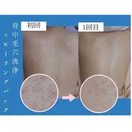 【背中ニキビ＆シミ】背中ケアキャンペーン！汗やムレによるニキビケア♪背中毛穴洗浄+肌別パック※クーポン内容要確認