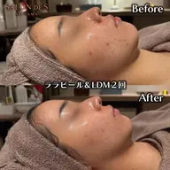 ♡話題のララピール♡で透明感UP&うるつや水光肌へ(🎀•͈ᴗ•͈)ꕤ