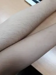 手脱毛