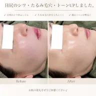 たるみ毛穴改善ハーブピーリング♪￥15,000円→￥11,800円ミニモ限定