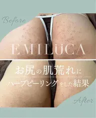 【剥離なし】お尻🌿ハーブピーリング