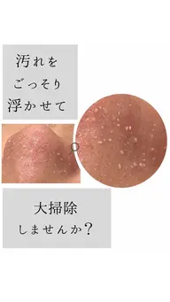 毛穴の汚れ大掃除しませんか?症例収集のため【無料モニター】を募集しています。