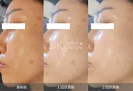 最新ピーリング*ダクトピール!ファンデ浮き・毛穴ザラつき改善◎つるんと陶器肌へ✨剥離なしで肌質改善♪くすみ/ニキビ/艶