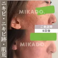 【ハーブピーリング/毛穴/クレーター/たるみ】◆GP3Days90分◆¥33000→¥26400