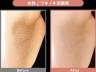 *ワンコイン!美肌(脱毛➕フォトフラッシュ)脱毛 脇