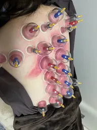 吸玉(カッピング)