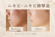 🌟💫自分史上最高の肌💫🌟クリニック監修グロースファクターの贅沢エステ💉ニキビ・たるみ・シミ・毛穴肌
