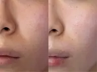フェイスワックス脱毛🧡