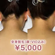 【限定クーポン⭐︎】人気No1👑全身脱毛(顔・VIO込み) ¥5,000
