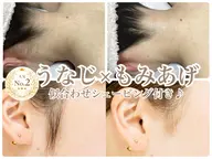 【NO2★】《女性◆IPL脱毛》似合わせ🫶🏻うなじ×もみあげ脱毛¥4980