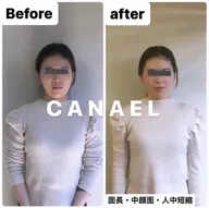 【頭蓋骨/小顔矯正】顔が長い/面長/中顔面短縮コース