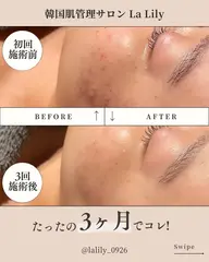 韓国式無針水光施術ミコステラ【ご新規様限定】