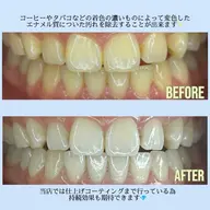 【初回限定】セルフホワイトニング3回✖️1コース(トリートメント付✨)通常7980円→3980円🦷💎食事制限なし