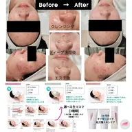🫧皮脂毛穴ケア🫧全身エステ+1ヶ月分オーダーメイドスキンケア付き📝