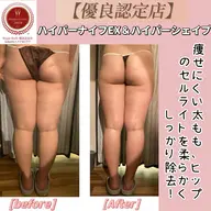 【まずお試し！痩身45分】ハイパーナイフEX＆シェイプ燃焼&強圧リンパ12800→8800