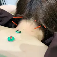トリガーポイント・ボディケア鍼灸