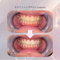 【U24学割】ナチュラルホワイトニング20分 ¥3,500