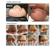 7月スタート!導入キャンペーン♪7500円→6500円!軽度巻き爪の方　フットワンカラー